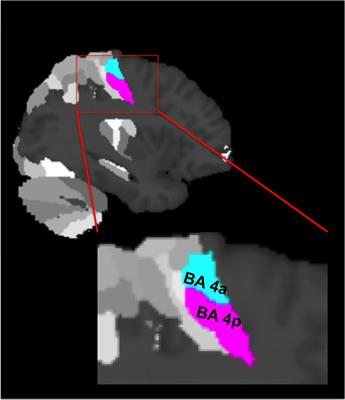 Blood Oxygenation Level-Dependent Response to Multiple Grip Forces in Multiple Sclerosis: Going Beyond the Main Effect of Movement in Brodmann Area 4a and 4p